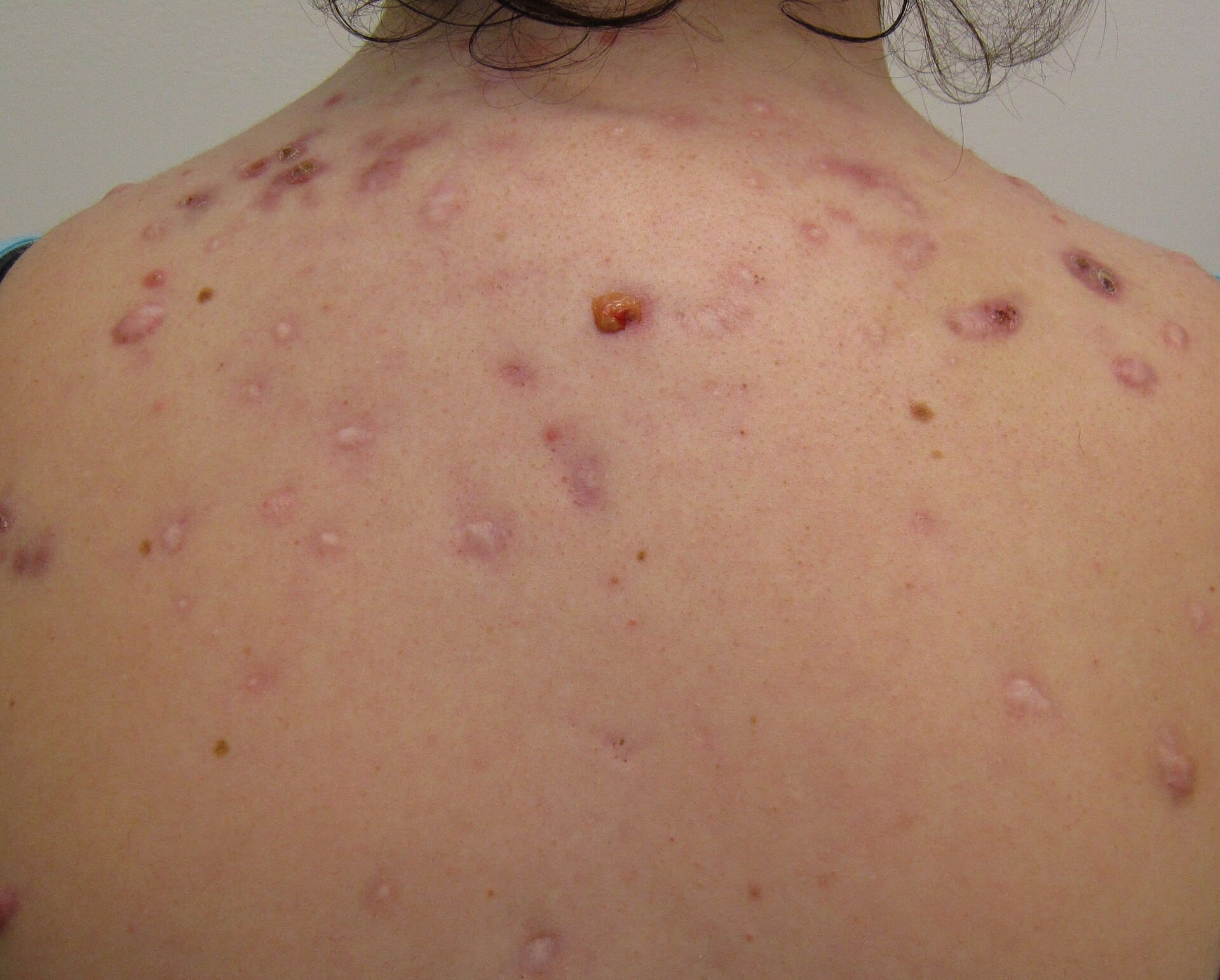 Back with severe inflammatory acne